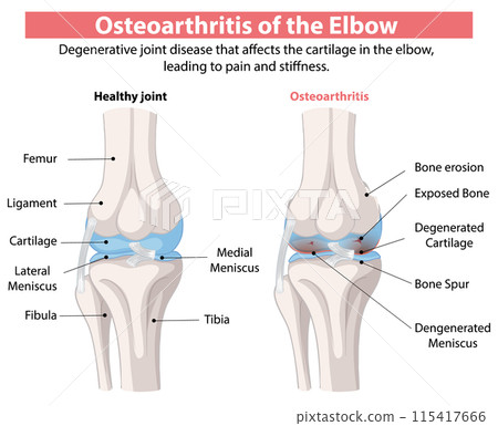 Osteoarthritis of the Elbow 115417666