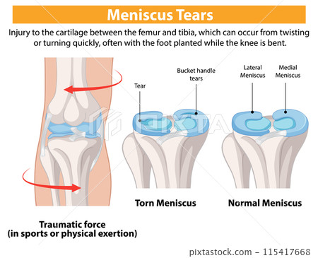 Understanding Meniscus Tears in Knees Understanding Meniscus Tears in Knees 115417668
