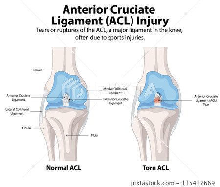 ACL Injury: Normal vs. Torn ACL Injury: Normal vs. Torn 115417669