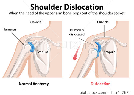 Shoulder Dislocation Anatomy Illustration 115417671