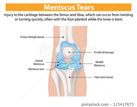 Meniscus Tear in the Knee Meniscus Tear in the Knee 115417673