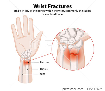 Understanding Wrist Fractures Understanding Wrist Fractures 115417674