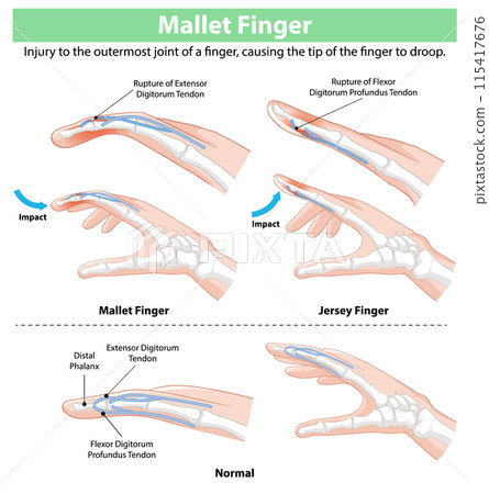 Mallet Finger Injury Illustration 115417676