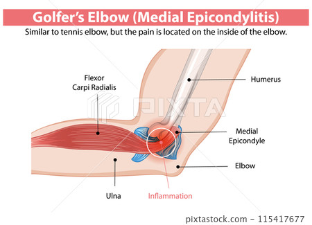 Golfer's Elbow Anatomy Illustration 115417677