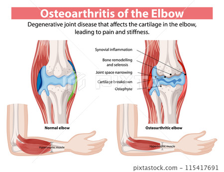 Osteoarthritis of the Elbow Osteoarthritis of the Elbow 115417691