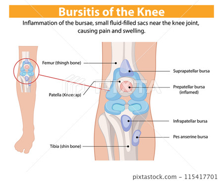 Bursitis of the Knee Illustration 115417701
