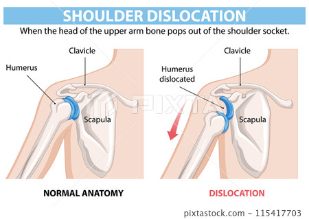Shoulder Dislocation Anatomy Illustration Shoulder Dislocation Anatomy Illustration 115417703