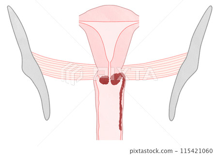 Cervical cancer stage IIIA (stage 3A) - Easy-to-understand illustration 115421060