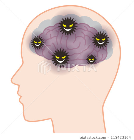 The brain of a person with dementia shrinks due to accumulated waste in the brain 115423164