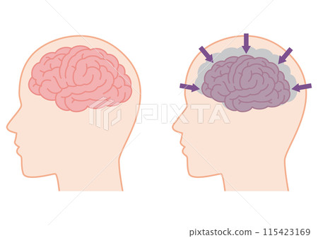 健康的大腦和因癡呆症而萎縮的大腦 115423169