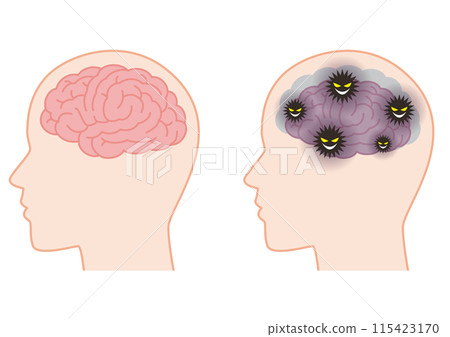 A healthy brain and a brain that has shrunk due to the accumulation of waste A healthy brain and a brain that has shrunk due to the accumulation of waste 115423170
