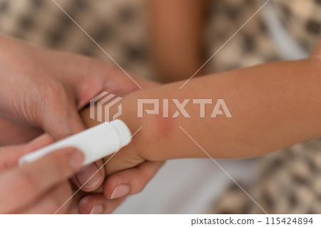 mother applying antiallergic cream on red spot at baby arm after red bite of mosquito 115424894