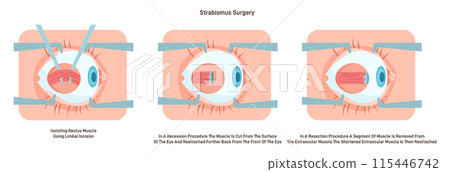 Strabismus surgery. Eye muscle recession, cutting the muscle from the surface of the eye and reattaching it further back. Extraocular muscles anatomy. Flat vector illustration 115446742