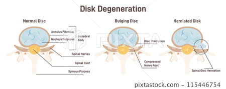 Disc degeneration stages set. flat Spine vertebrae anatomy scheme, healthy lumbar and medical conditions - bulging and herniated disc. Educational medical information. Flat vector illustration 115446754