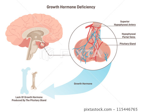 Growth hormone deficiency. Syndrome characterized by insufficient secretion of growth hormone, hypophyseal pituitary gland work congenital or acquired pathology. Flat vector illustration Growth hormone deficiency. Syndrome characterized by insufficient secretion of growth hormone, hypophyseal pituitary gland work congenital or acquired pathology. Flat vector illustration 115446765