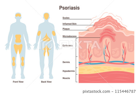 Psoriasis. Autoimmune disease characterized by areas of inflamed skin. Psoriasis plaque cross section structure. Dermatology disease. Flat vector illustration 115446787
