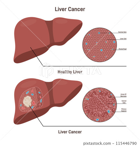 Liver cancer. Comparison between healthy organ and liver with carcinoma diagnosis. Liver cell strucure, human organ responsible for detoxification the organism. Flat vector illustration Liver cancer. Comparison between healthy organ and liver with carcinoma diagnosis. Liver cell strucure, human organ responsible for detoxification the organism. Flat vector illustration 115446790
