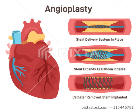 Angioplasty. Stent delivery and implantation. Deflated balloon catheter inserted into a coronary artery. Stent expanding a blood vessel wall. Flat vector illustration 115446791
