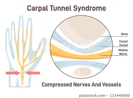 Carpal tunnel syndrome. Compressed median nerve. Carpal tunnel anatomy. Sensations of the fingers, thumb and palm. Flat vector illustration Carpal tunnel syndrome. Compressed median nerve. Carpal tunnel anatomy. Sensations of the fingers, thumb and palm. Flat vector illustration 115446800