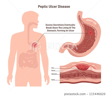 Peptic ulcer disease. Stomach wall with a sore on the lining. Digestive tract organ disorder. Flat vector illustration. 115446820
