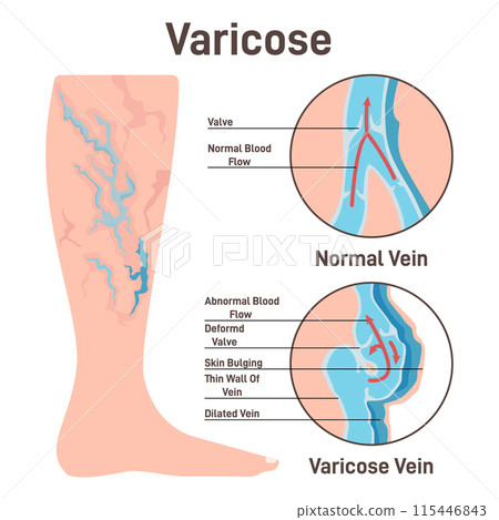 Varicoses. Anatomical diagram of varicose vein and normal healthy vein. Damaged, twisted and enlarged vessel obstruct blood flow. Flat vector illustration Varicoses. Anatomical diagram of varicose vein and normal healthy vein. Damaged, twisted and enlarged vessel obstruct blood flow. Flat vector illustration 115446843