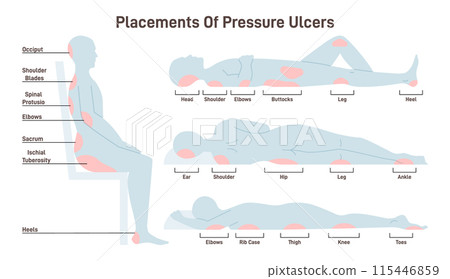 Pressure ulcers placements. Pressure sores areas on human body parts. Bedsore positions. Flat vector illustration. 115446859