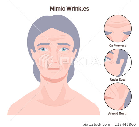 Mimic wrinkles. Age-related skin changes. Aging process, forehead, under eye and mouth skin changes, woman getting wrinkles with age. Flat vector illustration Mimic wrinkles. Age-related skin changes. Aging process, forehead, under eye and mouth skin changes, woman getting wrinkles with age. Flat vector illustration 115446860