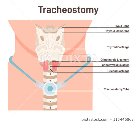 Tracheostomy. Tracheal surgery neutralise airway obstruction. Plastic cannula with inflatable cuff. Trachea anatomy. Flat vector illustration Tracheostomy. Tracheal surgery neutralise airway obstruction. Plastic cannula with inflatable cuff. Trachea anatomy. Flat vector illustration 115446862