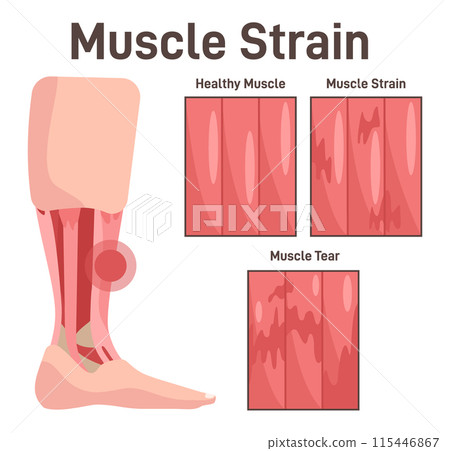 Leg muscle injury. Muscle strain at different stages, healthy, strained and teared. Didactic scheme of anatomy of human muscular system. Flat vector illustration Leg muscle injury. Muscle strain at different stages, healthy, strained and teared. Didactic scheme of anatomy of human muscular system. Flat vector illustration 115446867