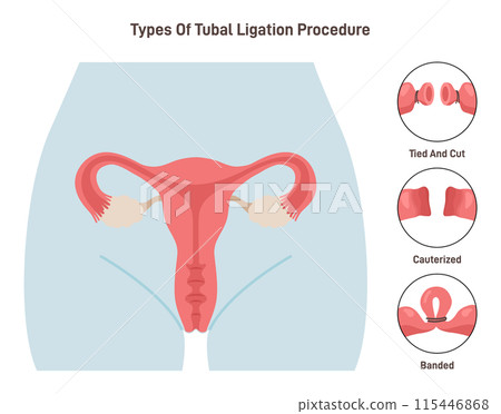 Tubal ligation surgery. Permanent birth control procedure types. Tubes blockage prevent egg fertilization. Flat vector illustration Tubal ligation surgery. Permanent birth control procedure types. Tubes blockage prevent egg fertilization. Flat vector illustration 115446868