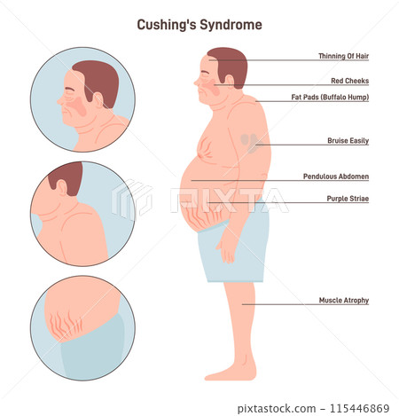 Cushing's syndrome. Excess cortisol production. Male figure with disease symptoms. Flat vector illustration 115446869