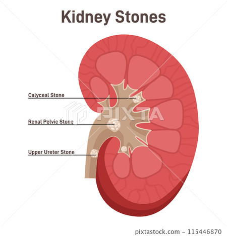Nephrolithiasis. Kidney stones disease. Nephrology and urology studying. Anatomy of human body, excretory system studying. Flat vector illustration 115446870