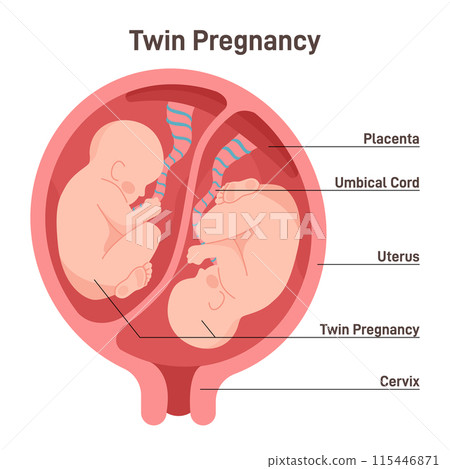 Twin pregnancy. Anatomy of womb with twin fetuses. Dizygotic twins placement. Flat vector illustration Twin pregnancy. Anatomy of womb with twin fetuses. Dizygotic twins placement. Flat vector illustration 115446871