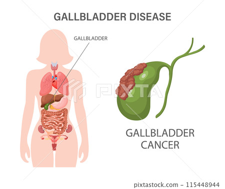 Gallbladder diseases infographic banner. Gallstone disease, cancer, cholangitis or polyps of the digestive system. Medicine and healthcare. Illustration. 115448944