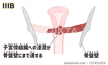 Cervical cancer stage IIIB (stage 3B) - Easy-to-understand Japanese illustrations Cervical cancer stage IIIB (stage 3B) - Easy-to-understand Japanese illustrations 115452919