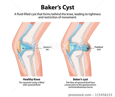 Popliteal Bursa Anatomy