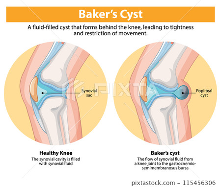 Baker's Cyst in Knee Joint 115456306