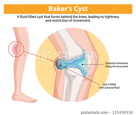 Baker's Cyst in the Knee 115456330