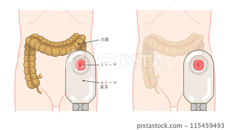 Colostomy, stoma, colon, illustration Colostomy, stoma, colon, illustration 115459493