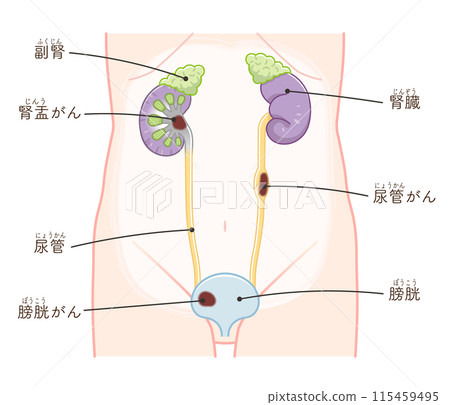 Kidney, ureter, bladder, kidney cancer, renal pelvis cancer, cancer, ureter cancer, bladder cancer, illustration 115459495