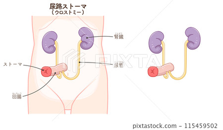 Urinary stoma, stoma, urostomy, ostomate, large intestine, small intestine, bladder, illustration, i Urinary stoma, stoma, urostomy, ostomate, large intestine, small intestine, bladder, illustration, i 115459502