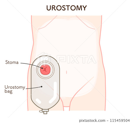 泌尿道造口、造口、尿造口、造口、造口、大腸、小腸、膀胱、插圖、i 泌尿道造口、造口、尿造口、造口、造口、大腸、小腸、膀胱、插圖、i 115459504