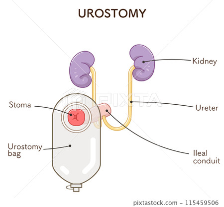 Urinary stoma, stoma, urostomy, ostomate, large intestine, small intestine, bladder, illustration, i Urinary stoma, stoma, urostomy, ostomate, large intestine, small intestine, bladder, illustration, i 115459506