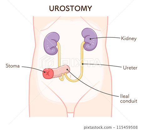 Urinary stoma, stoma, urostomy, ostomate, large intestine, small intestine, bladder, illustration, i 115459508
