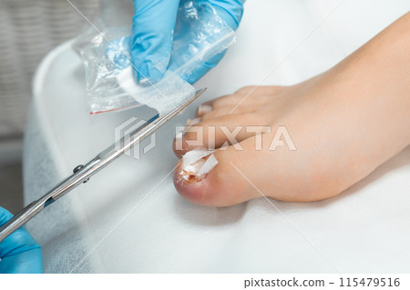 Close up podiatrist applies a bandage after an ingrown toenail removal procedure. Close up podiatrist applies a bandage after an ingrown toenail removal procedure. 115479516