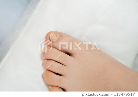 A womans feet after appling a titanium thread to a toenail. A womans feet after appling a titanium thread to a toenail. 115479517
