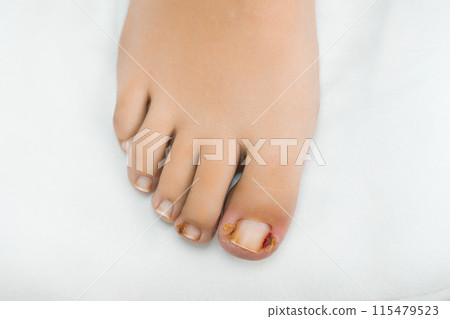Close up woman feet after removing ingrown toenails. Close up woman feet after removing ingrown toenails. 115479523
