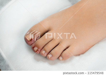 Top view of woman feet after podologist treatment. Top view of woman feet after podologist treatment. 115479548