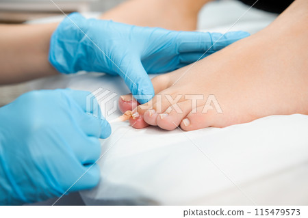 Close up podologist treats the nail with an antifungal agent.  115479573