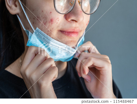Close up of young Asian woman open her mask and showing acne problem occur on her skin caused of wearing mask for longtime. 115488467